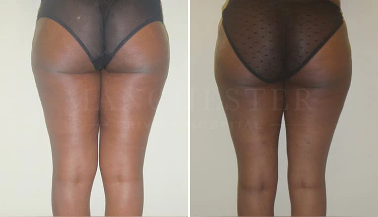 vaser-lipo-thighs-before-after