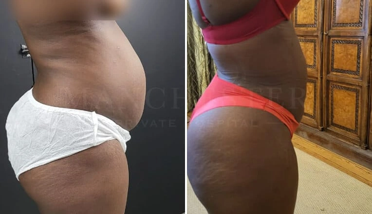 vaser-liposuction-before-and-after-uk-2