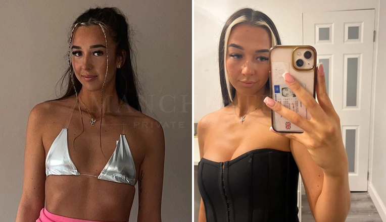 boob job before and after patient-6-v2