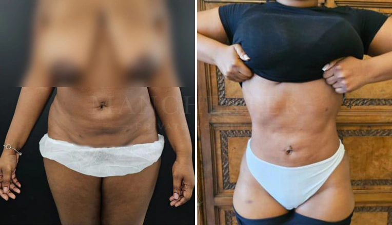 vaser lipo female stomach before and after-8