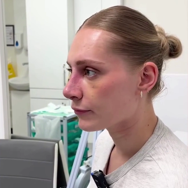 eve rhinoplasty patient