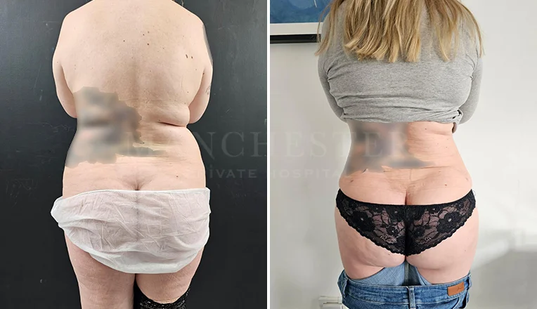 back vaser lipo before and after-8