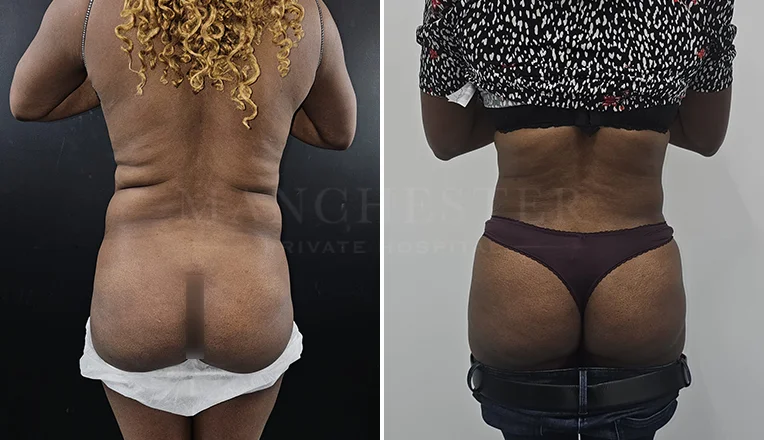 back vaser liposuction before and after-7