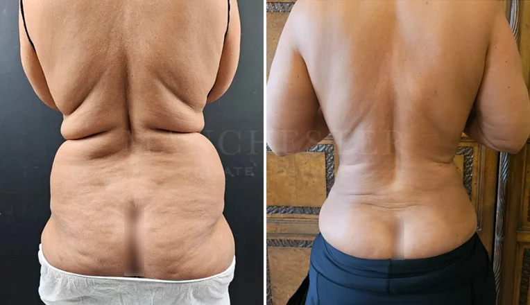 back vaser liposuction before and after-8