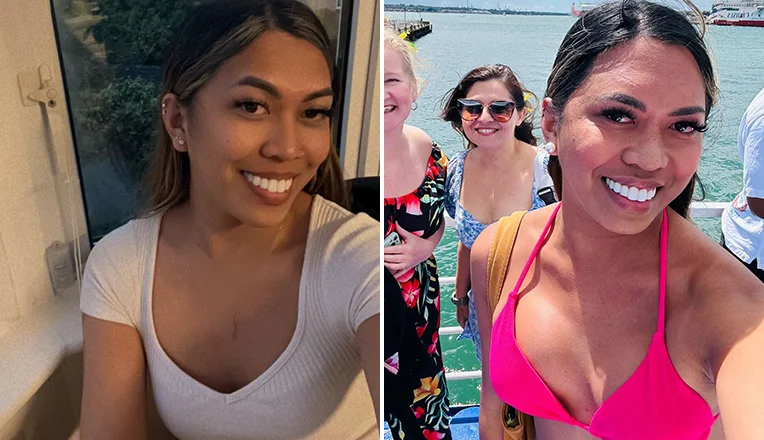 boob job before and after patient-13-v1