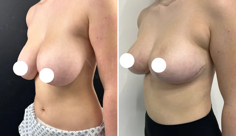 breast reduction before and after 10 week results-3