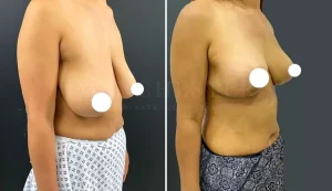 breast uplift before and after-5