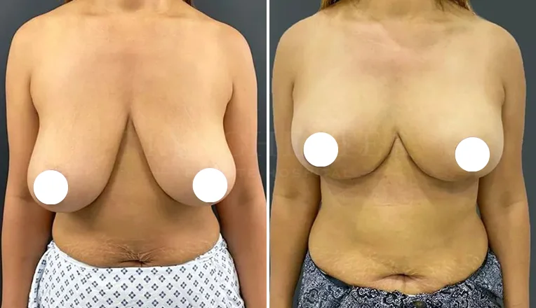 breast uplift before and after-5-v2