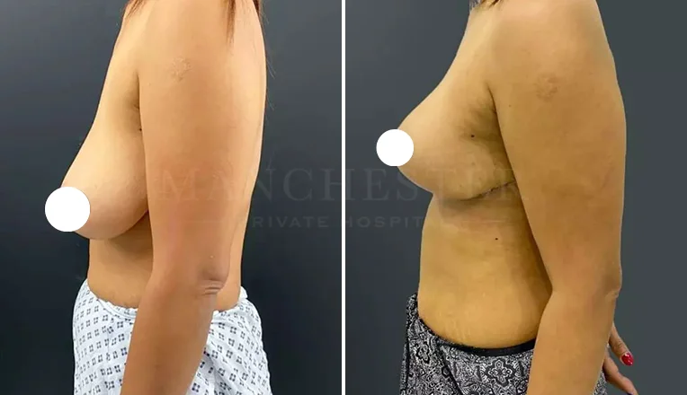 breast uplift before and after-5-v4