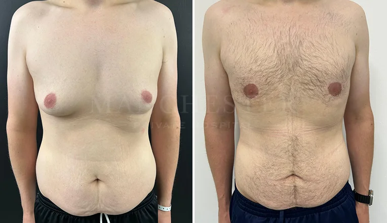 gynecomastia liposuction before and after patient-8