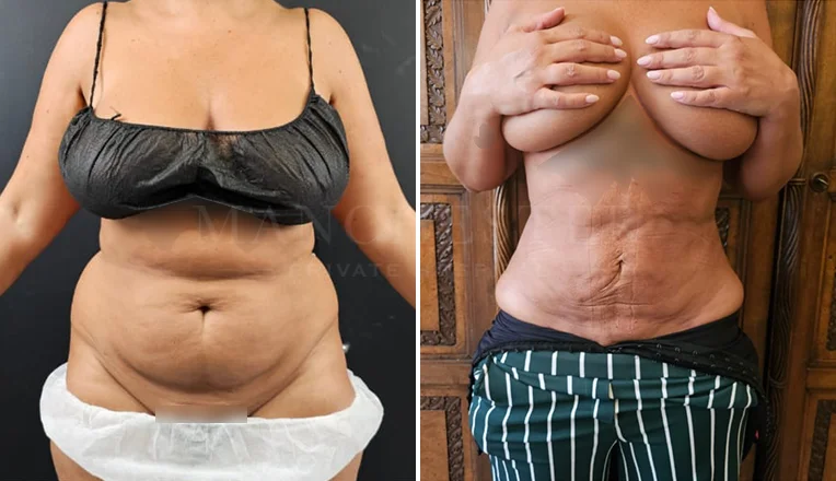 stomach vaser liposuction before and after-12