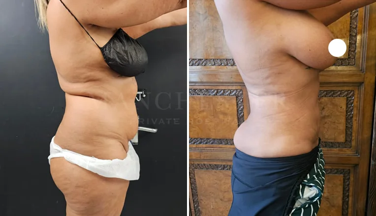 vaser lipo female abs before and after-12-v1