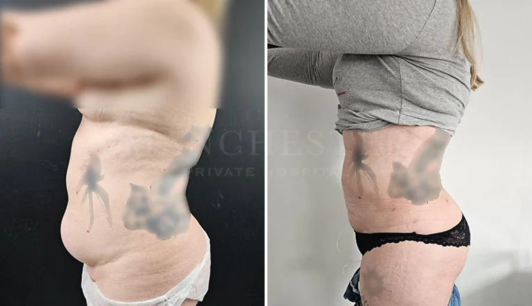 vaser lipo female abs before and after-13-v1