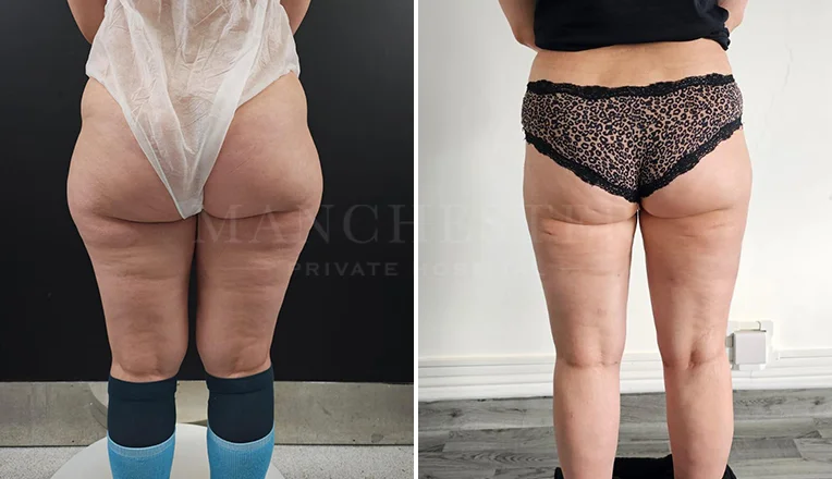 vaser liposuction legs before and after patient-7-v1