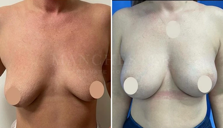 breast augmentation before and after-1