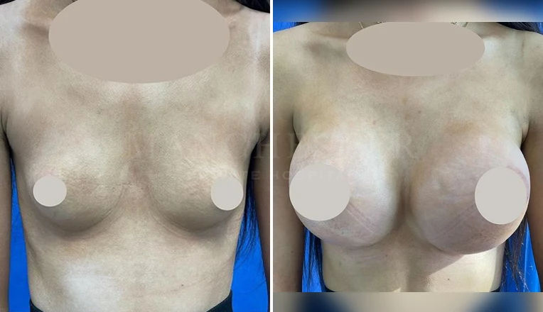 breast augmentation before and after-3-v1