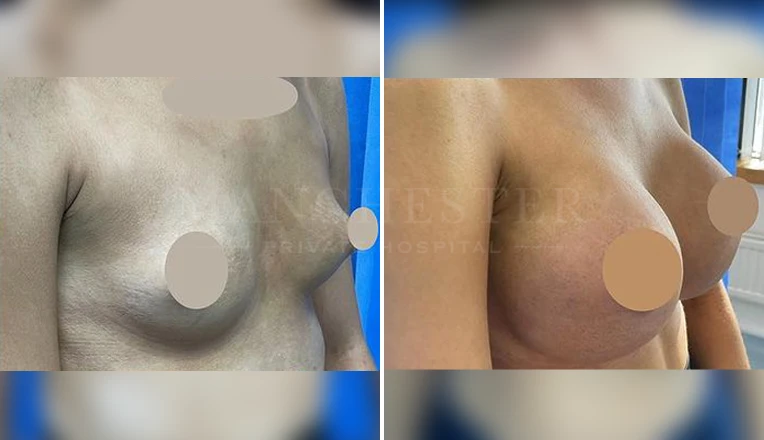 breast augmentation before and after-3