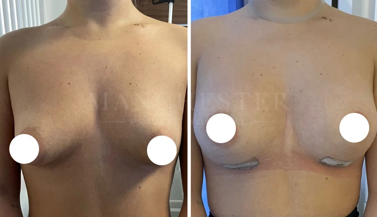 breast augmentation before and after-4