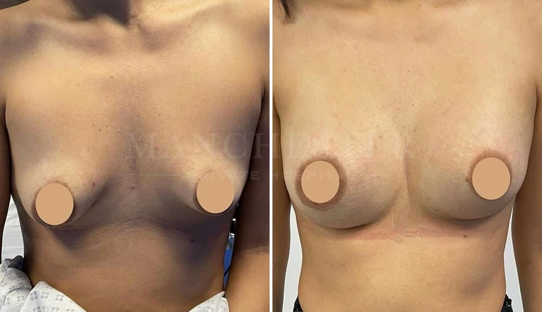 breast augmentation before and after