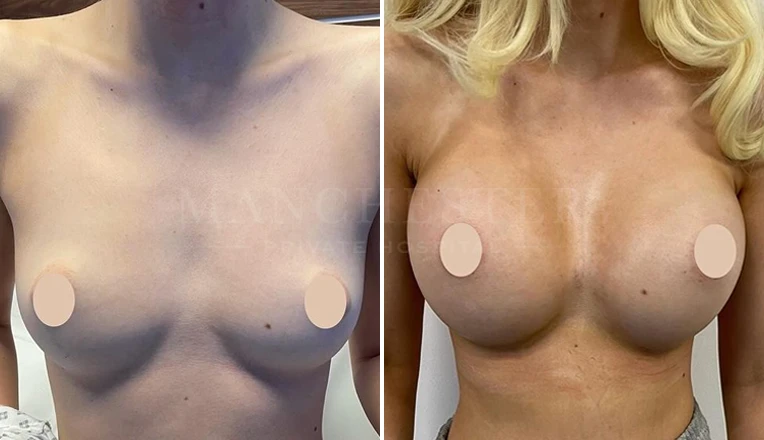 breast enlargement before and after-1