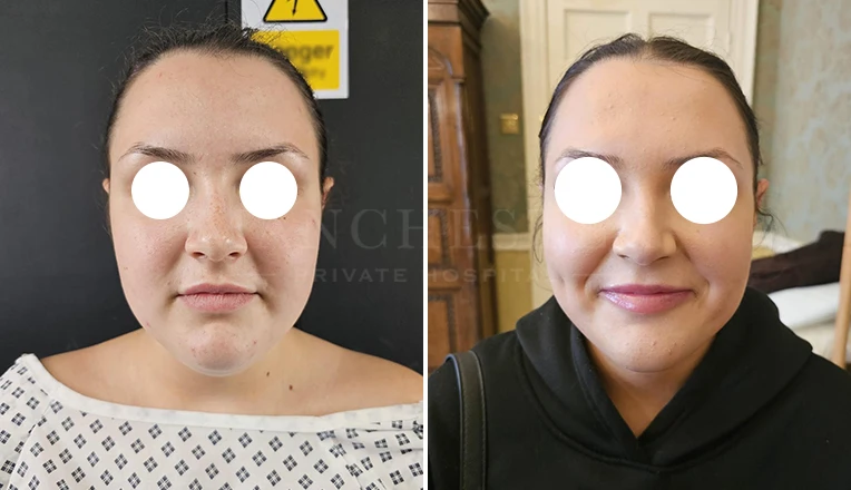 chin vaser liposuction before and after-3