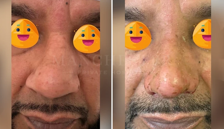 male rhinoplasty before afte results-1