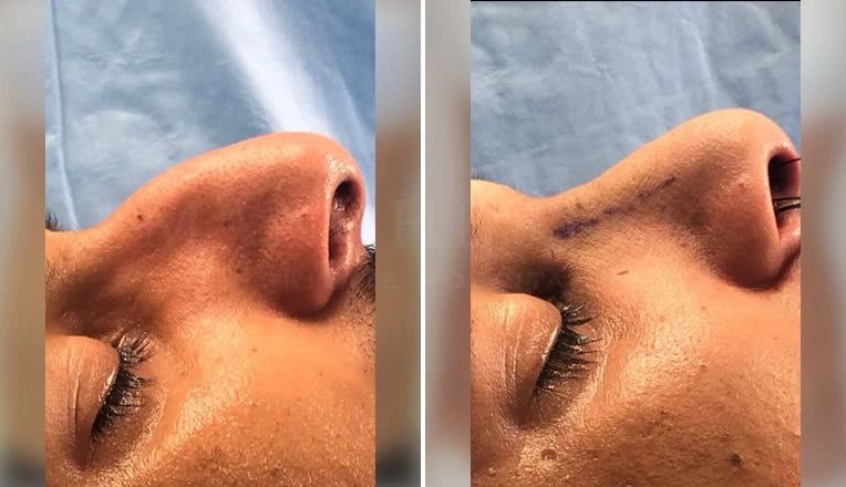 male rhinoplasty before after results