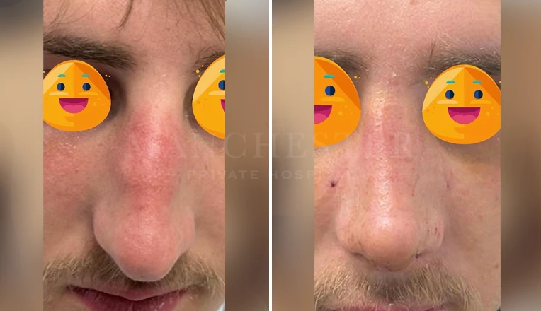 men nose job before and after result-1