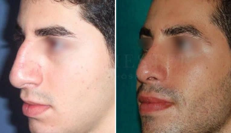 men nose job before and after result