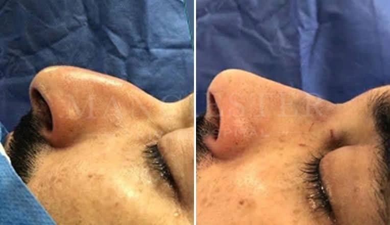 nose job before after result men