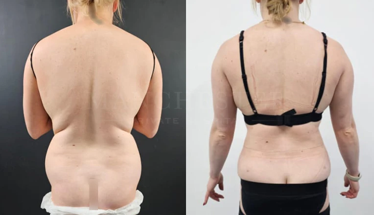 back vaser liposuction before and after result