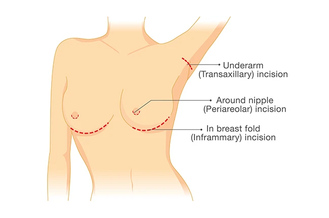 breast augmentation types of incisions