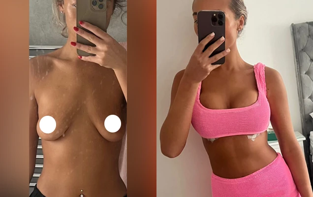 breast lift with implants patient result