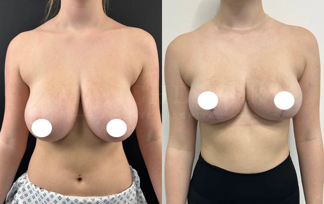 breast-reduction-before-and-after