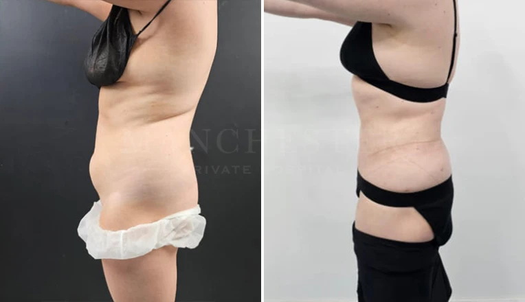 stomach vaser lipo before and after result