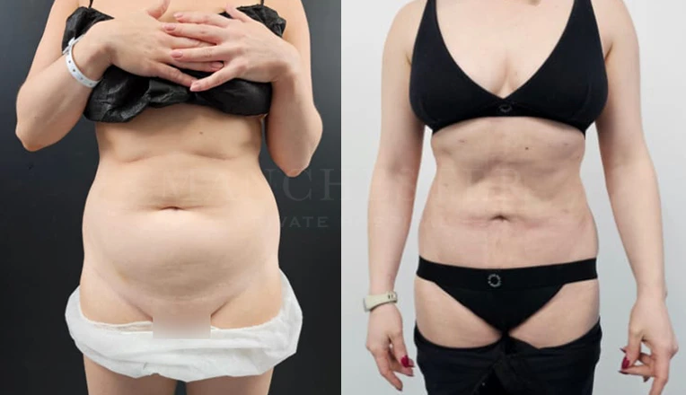 vaser lipo before and after stomach result