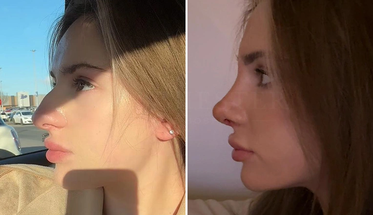 rhinoplasty before and after patient-14