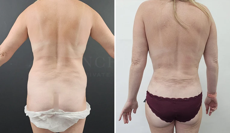 back vaser liposuction before and after result-12