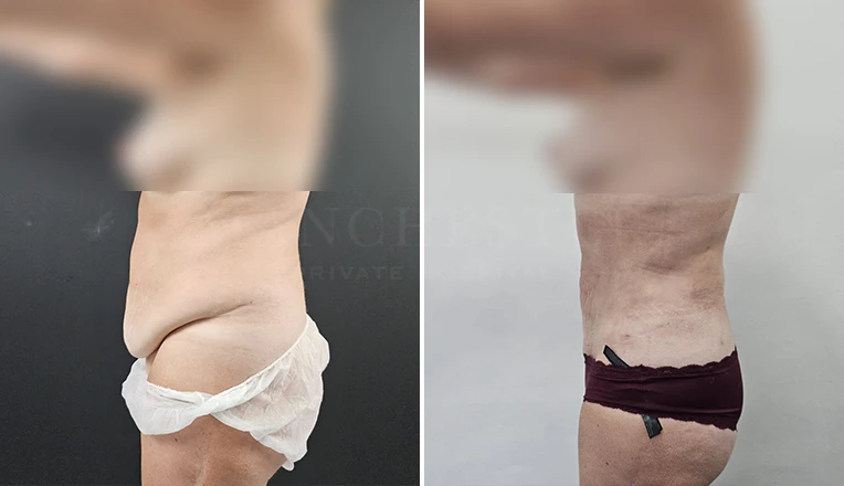 stomach vaser lipo before and after result-12-v1