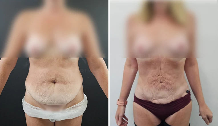 vaser lipo before and after stomach result-12