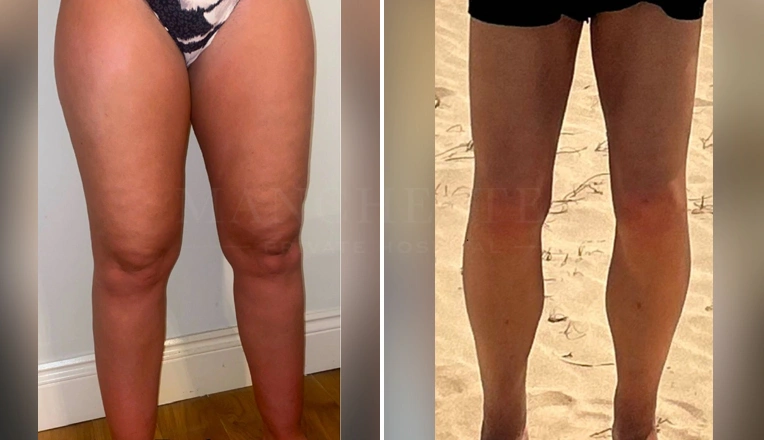 lipedema liposuction before and after patient-7-v1