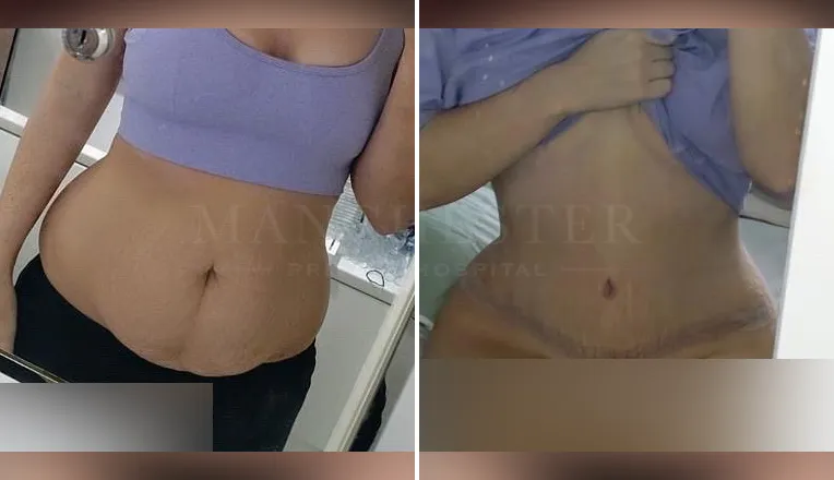 tummy tuck before and after 6 months result