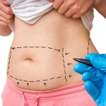 From 6 Months to 5 Years: A Complete Timeline of Tummy Tuck Scars and Long-Term Maintenance