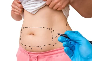 From 6 Months to 5 Years: A Complete Timeline of Tummy Tuck Scars and Long-Term Maintenance