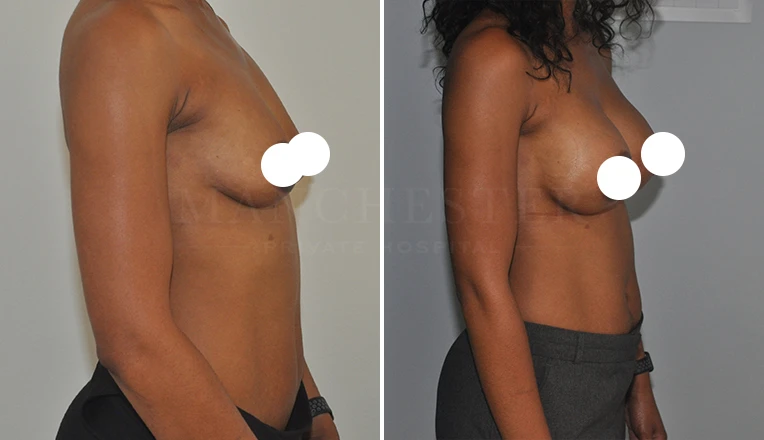 boob job before and after patient-23-v1