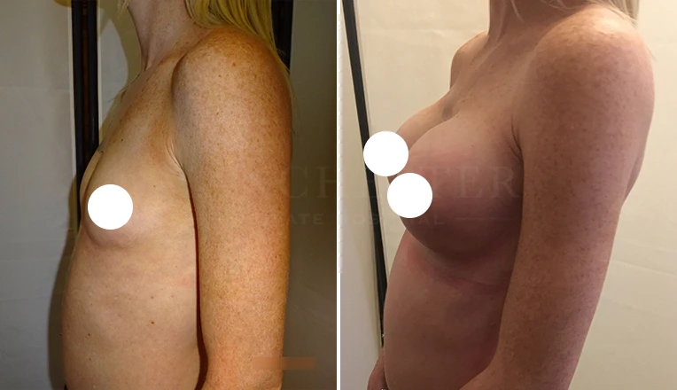 breast enlargement patient result-32-v2