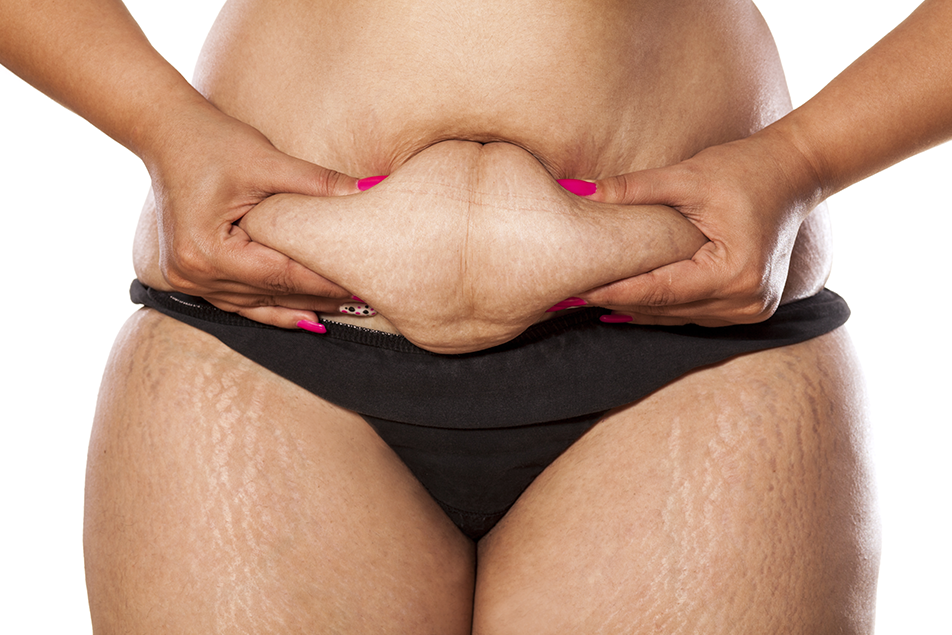 close-up of a woman’s abdomen with excess skin, demonstrating the appearance of an apron belly