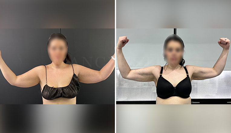 arm liposuction before and after