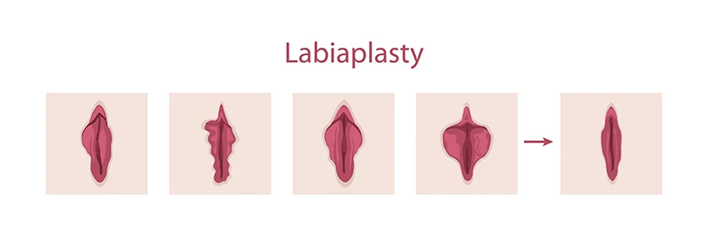 Diagram showing different labial shapes before a labiaplasty procedure, followed by a neater appearance post procedure.