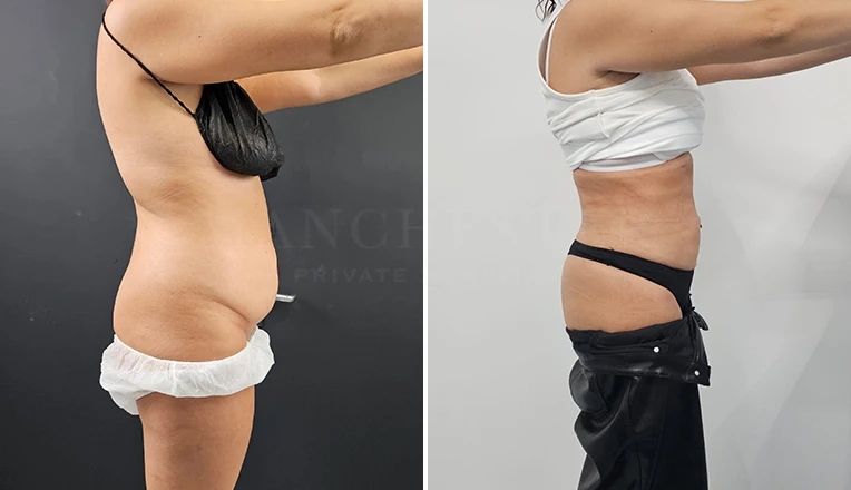 abdomen liposuction before and after result-v1